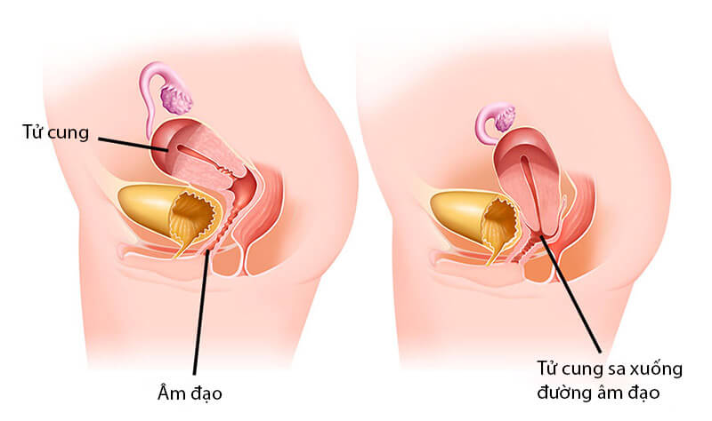Hình ảnh sa tử cung sau sinh
