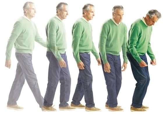 14 Biểu hiện của bệnh Parkinson- Run chân tay 3 Run tay chân