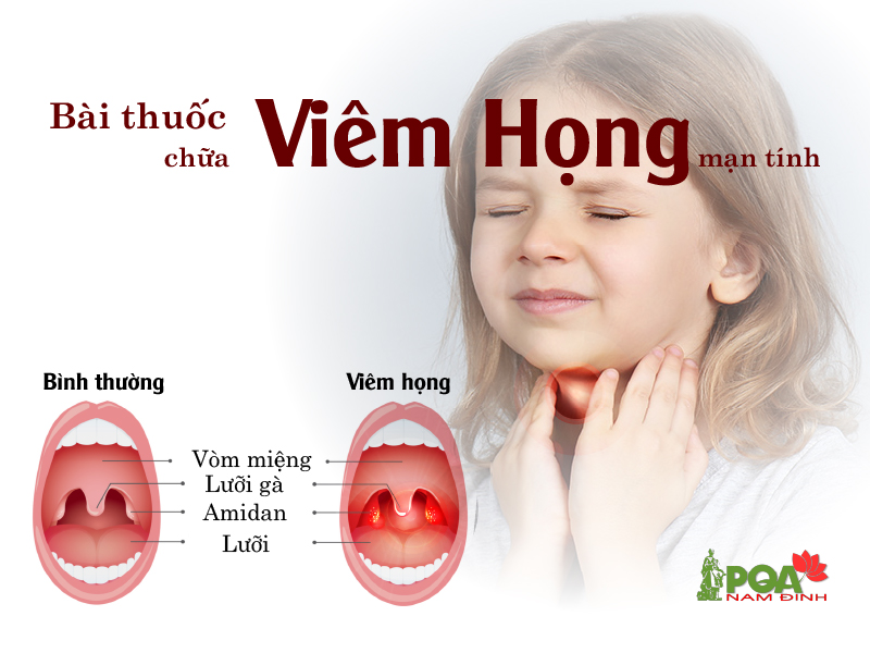 Bài thuốc chữa viêm họng mạn tính